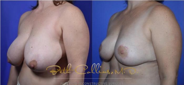 Before & After Breast Lift Case 121 View #4 View in Guilford, CT