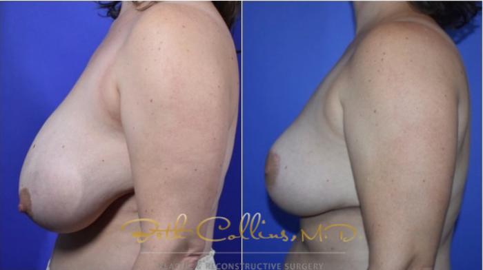 Before & After Breast Lift Case 121 View #5 View in Guilford, CT
