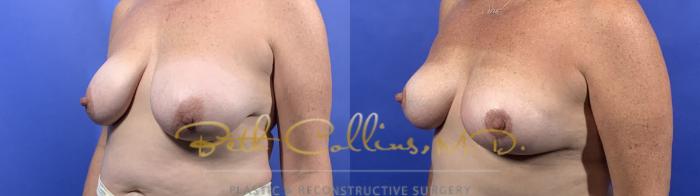 Before & After Breast Asymmetry Correction Case 132 Left Oblique View in Guilford, CT