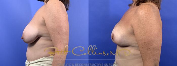 Before & After Breast Asymmetry Correction Case 132 Left Side View in Guilford, CT