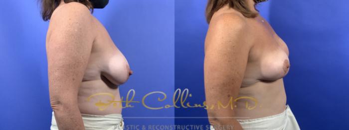 Before & After Breast Asymmetry Correction Case 132 Right Side View in Guilford, CT