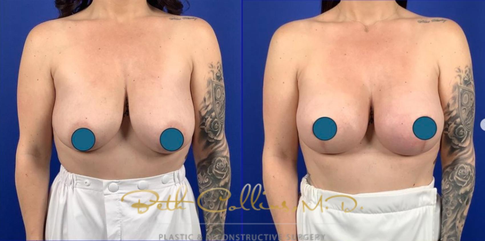 Before & After Breast Lift Case 259 Front View in Guilford, CT