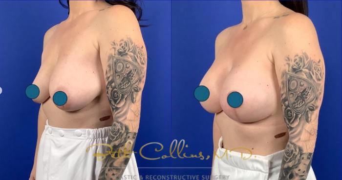 Before & After Breast Lift Case 259 Left Oblique View in Guilford, CT