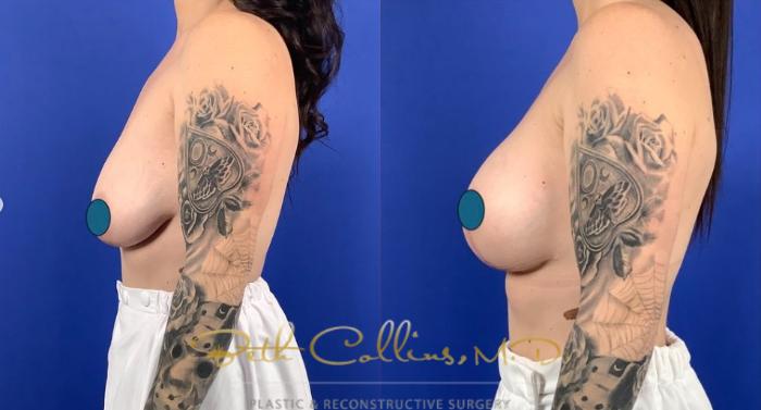 Before & After Breast Lift Case 259 Left Side View in Guilford, CT