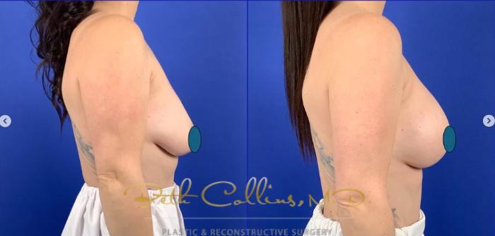 Before & After Breast Lift Case 259 Right Side View in Guilford, CT