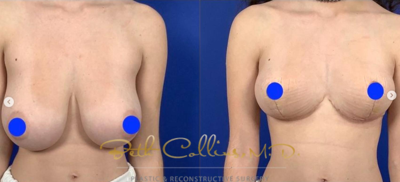 Before & After Breast Lift Case 282 Front View in Guilford, CT