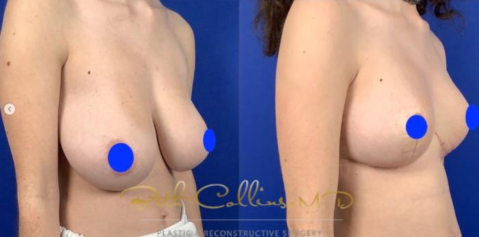 Before & After Breast Lift Case 282 Right Oblique View in Guilford, CT