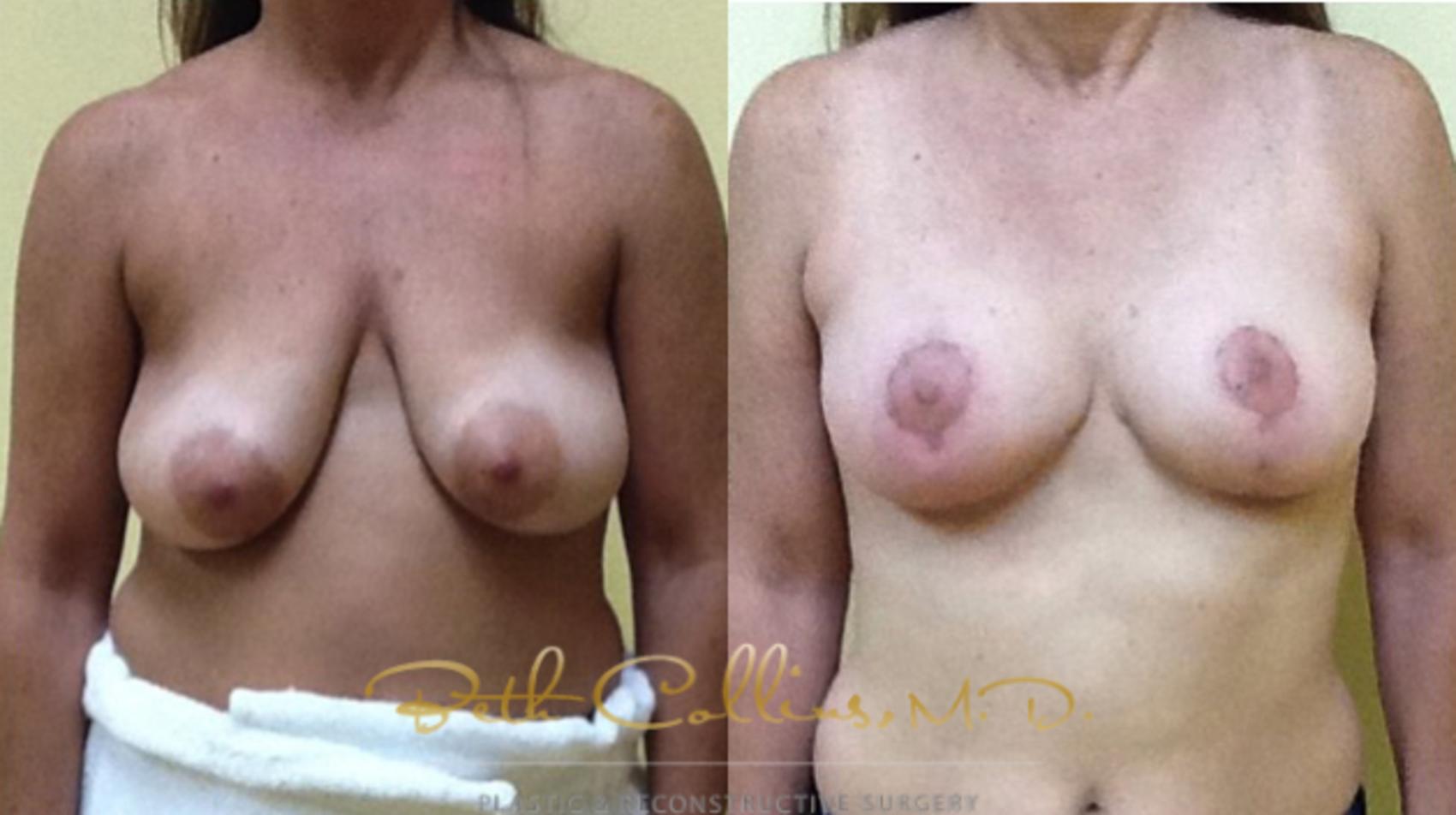 Breast Lift Case 35 Before & After View #1 | Guilford, CT | Beth Collins M.D.