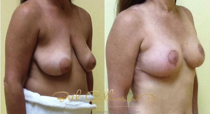 Before & After Breast Lift Case 35 View #2 View in Guilford, CT