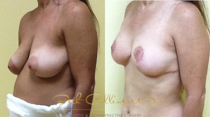 Before & After Breast Augmentation Case 35 View #3 View in Guilford, CT