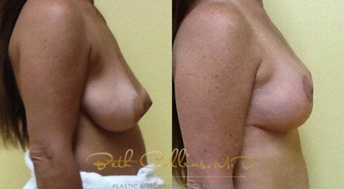 Before & After Breast Reduction Case 35 View #4 View in Guilford, CT