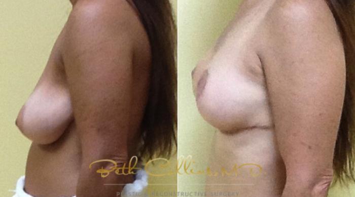 Before & After Breast Reduction Case 35 View #5 View in Guilford, CT