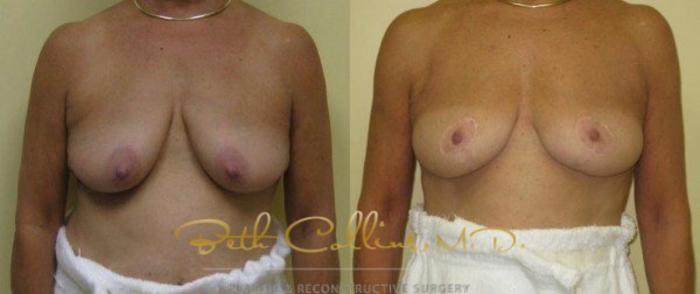 Before & After Breast Lift Case 36 View #1 View in Guilford, CT