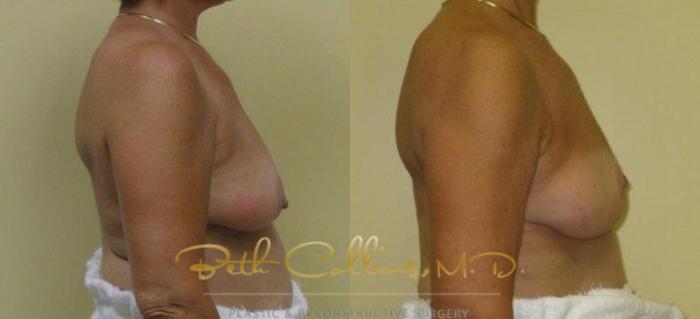 Before & After Breast Lift Case 36 View #2 View in Guilford, CT
