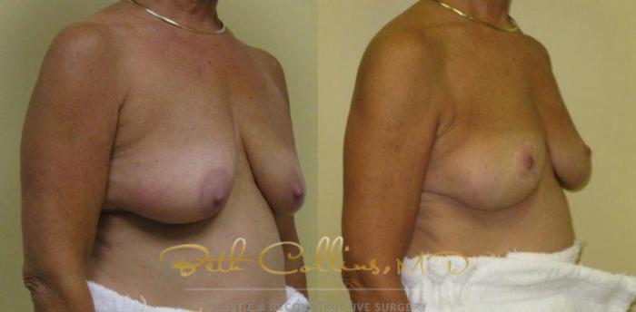 Before & After Breast Lift Case 36 View #3 View in Guilford, CT