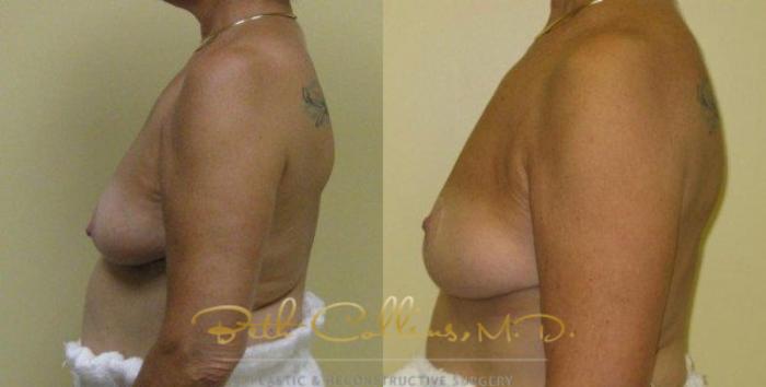 Before & After Breast Lift Case 36 View #4 View in Guilford, CT