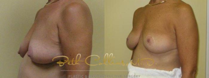 Before & After Breast Lift Case 36 View #5 View in Guilford, CT