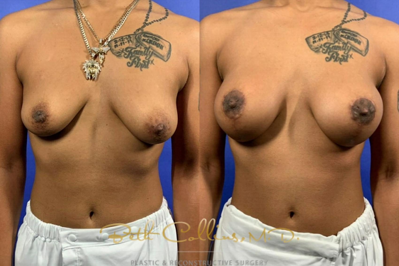 Breast augmentation with mastopexy