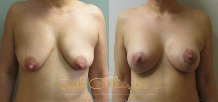 Before & After Breast Lift with Augmentation Case 24 View #1 View in Guilford, CT