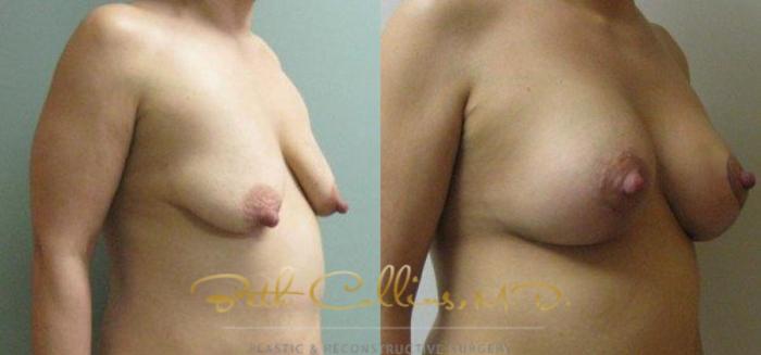 Before & After Breast Lift with Augmentation Case 24 View #2 View in Guilford, CT