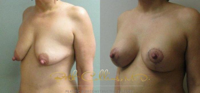 Before & After Breast Lift with Augmentation Case 24 View #4 View in Guilford, CT