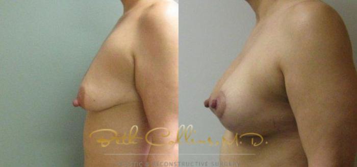Before & After Breast Lift with Augmentation Case 24 View #5 View in Guilford, CT