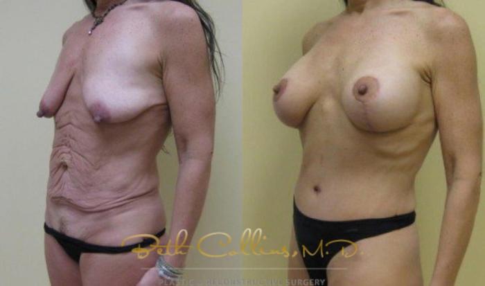 Before & After Breast Lift with Augmentation Case 25 View #1 View in Guilford, CT