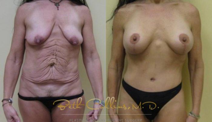 Before & After Breast Augmentation Case 25 View #2 View in Guilford, CT