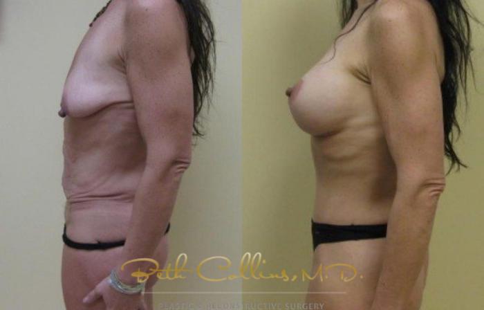 Before & After Breast Augmentation Case 25 View #3 View in Guilford, CT