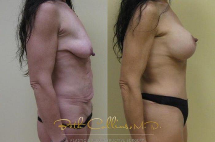 Before & After Breast Augmentation Case 25 View #4 View in Guilford, CT