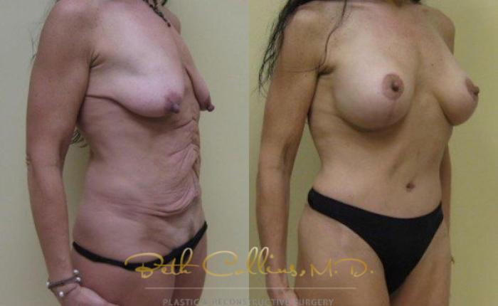 Before & After Tummy Tuck Case 25 View #5 View in Guilford, CT