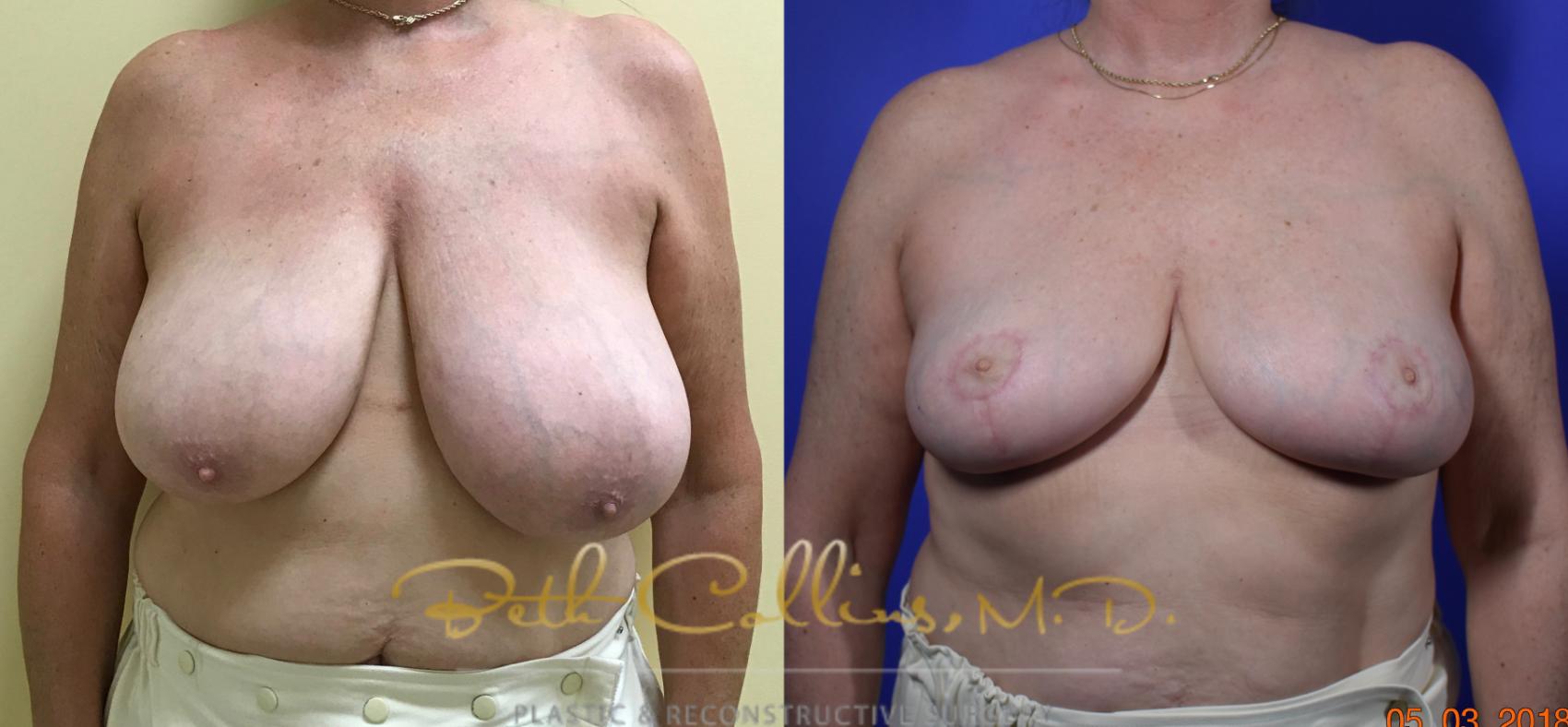 Before & After Breast Reduction Case 119 View #1 View in Guilford, CT
