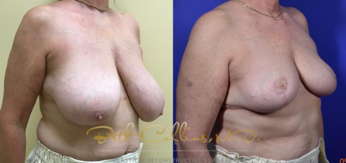 Before & After Breast Reduction Case 119 View #2 View in Guilford, CT