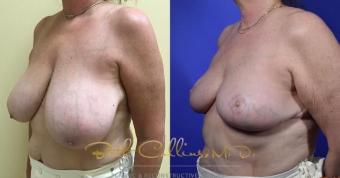 Before & After Breast Reduction Case 119 View #4 View in Guilford, CT
