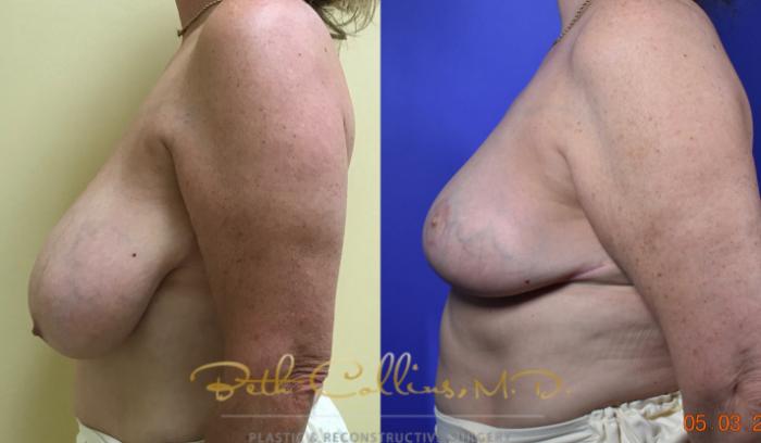 Before & After Breast Reduction Case 119 View #5 View in Guilford, CT