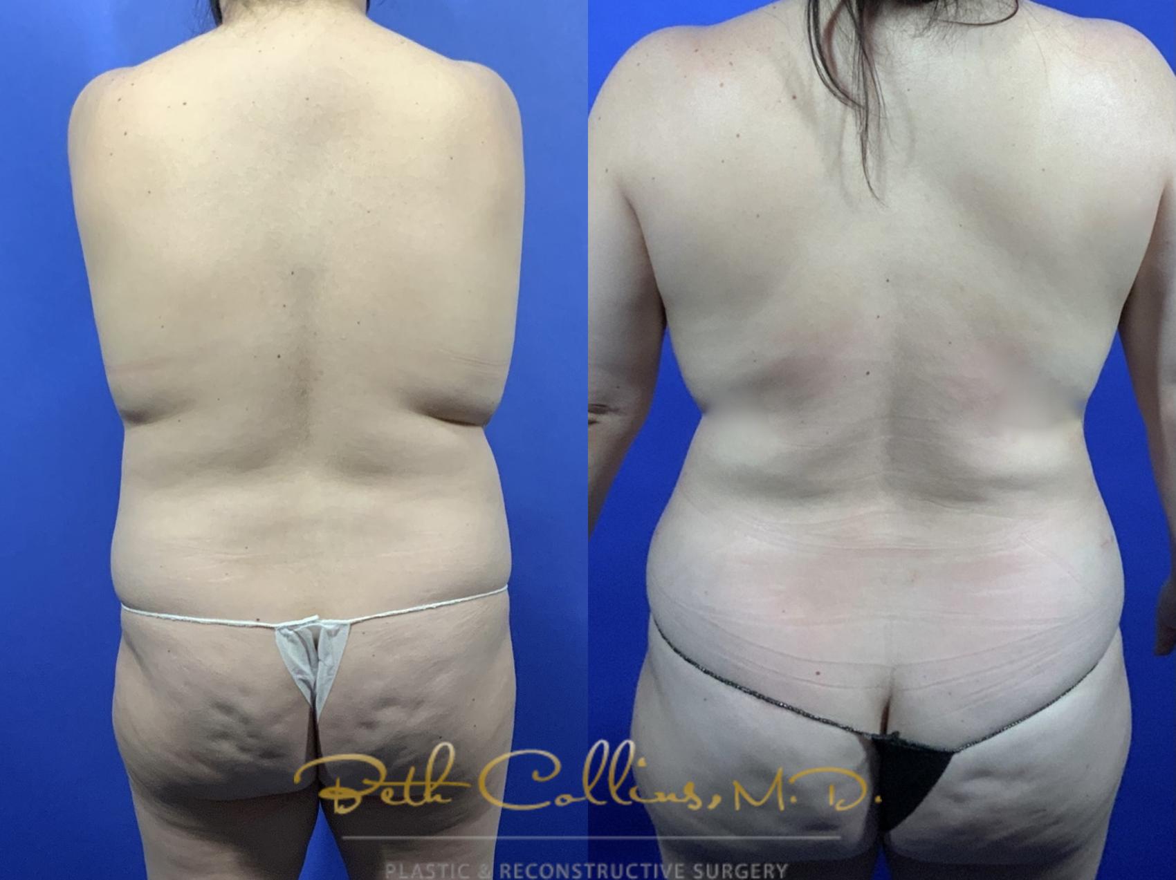 Back and flank liposuction