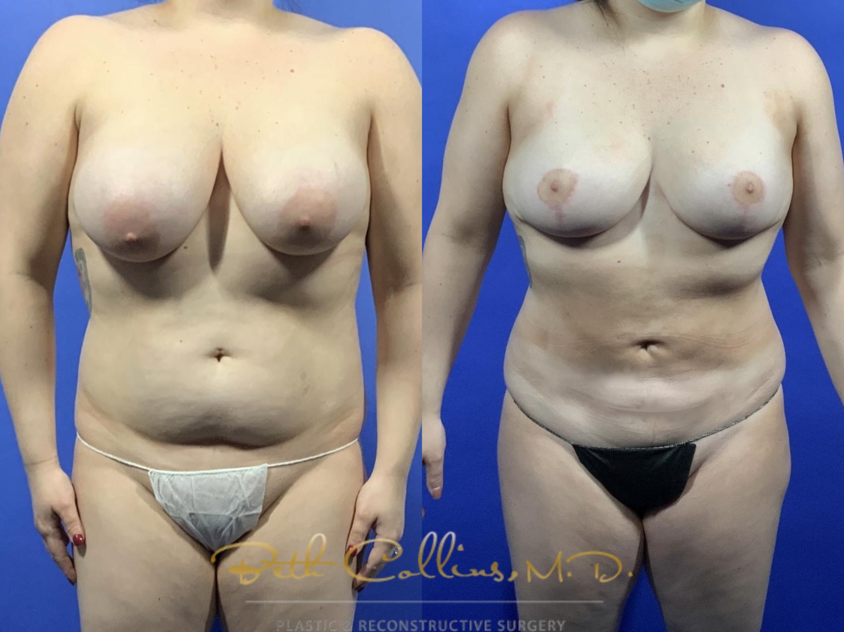 Breast reduction with abdominal liposuction