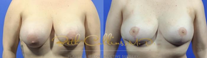 Breast reduction and reshaping