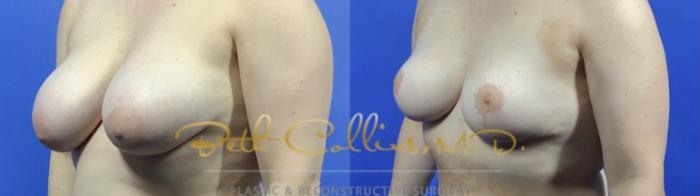 Bilateral breast reduction
