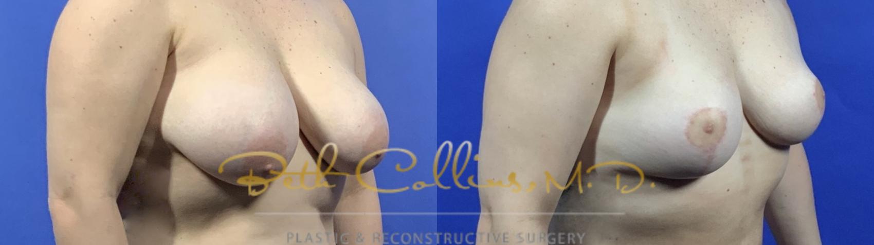 This young lady did not like the shape of her breasts and felt that they hung down too far. A breast reduction/lift was performed by Dr. Collins to lift and shape the breast.