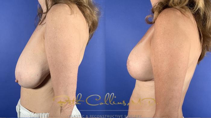 Breast reduction surgery has one of the highest satisfaction rates in all of plastic surgery. It has two functions. One is aesthetic; as you can see the overall balance of the smaller breast leads to a seemingly smaller and thinner overall appearance. The other is functional as many women with enlarged breasts suffer from back, neck and shoulder pain. In the vast majority of cases, reducing the size of the breasts relieves these symptoms. 