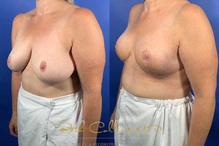 Bilateral Breast Reduction
