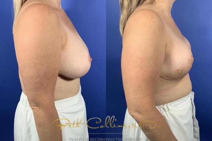 Bilateral Breast Reduction