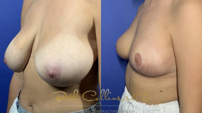 Breast reduction and lift