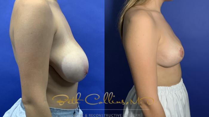 Breast reduction and lift