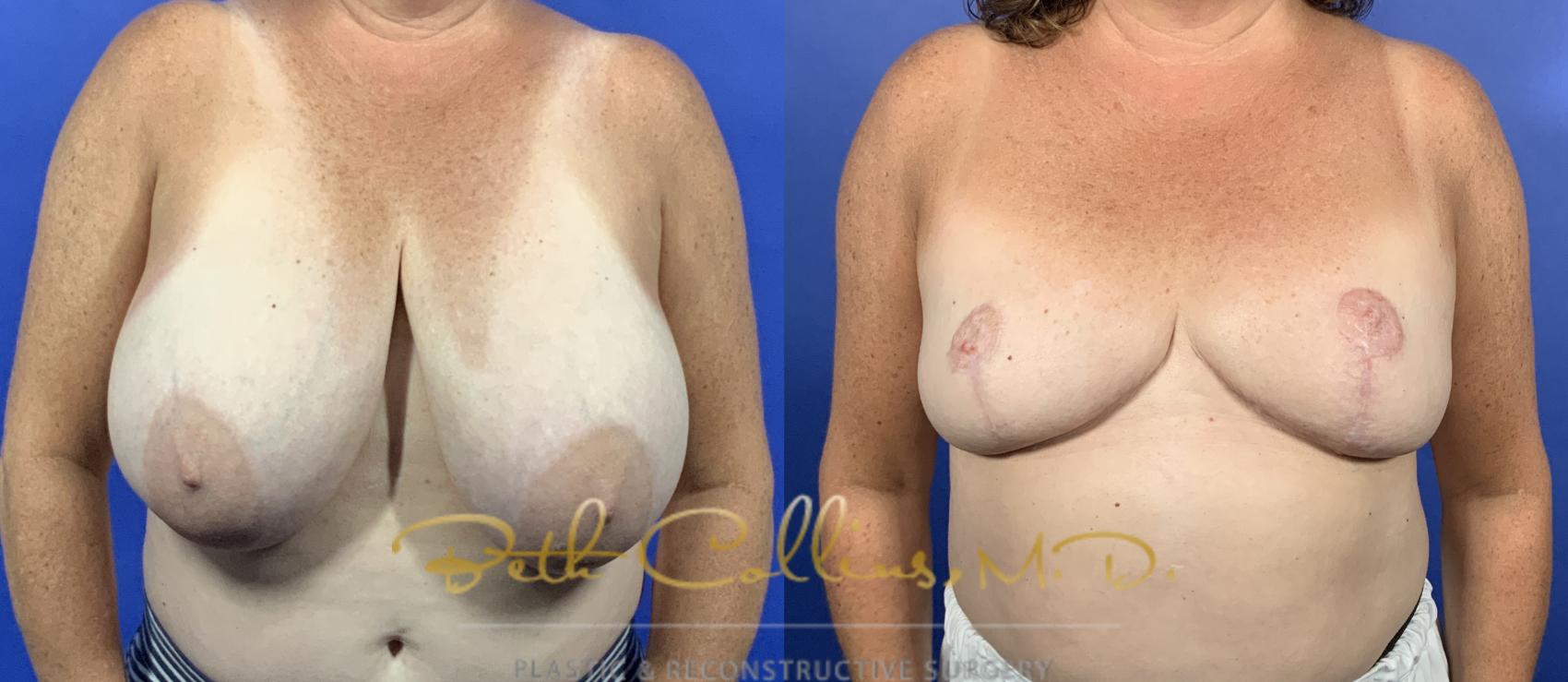 Breast Reduction with free nipple graft