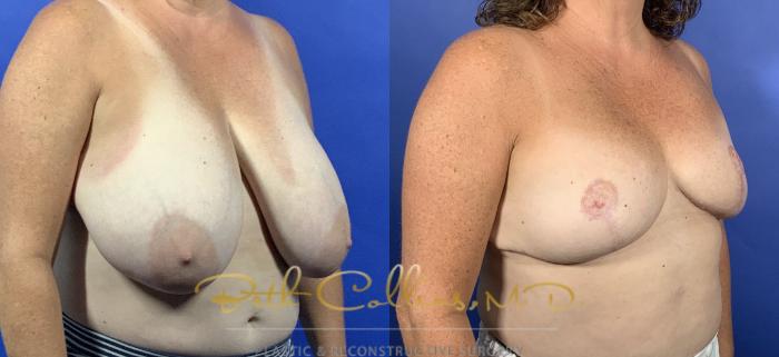 Breast Reduction with free nipple graft