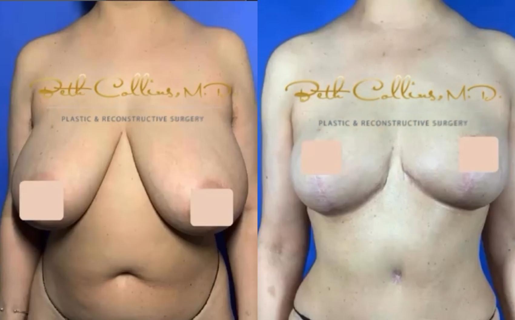 Before & After Breast Reduction Case 260 Front View in Guilford, CT