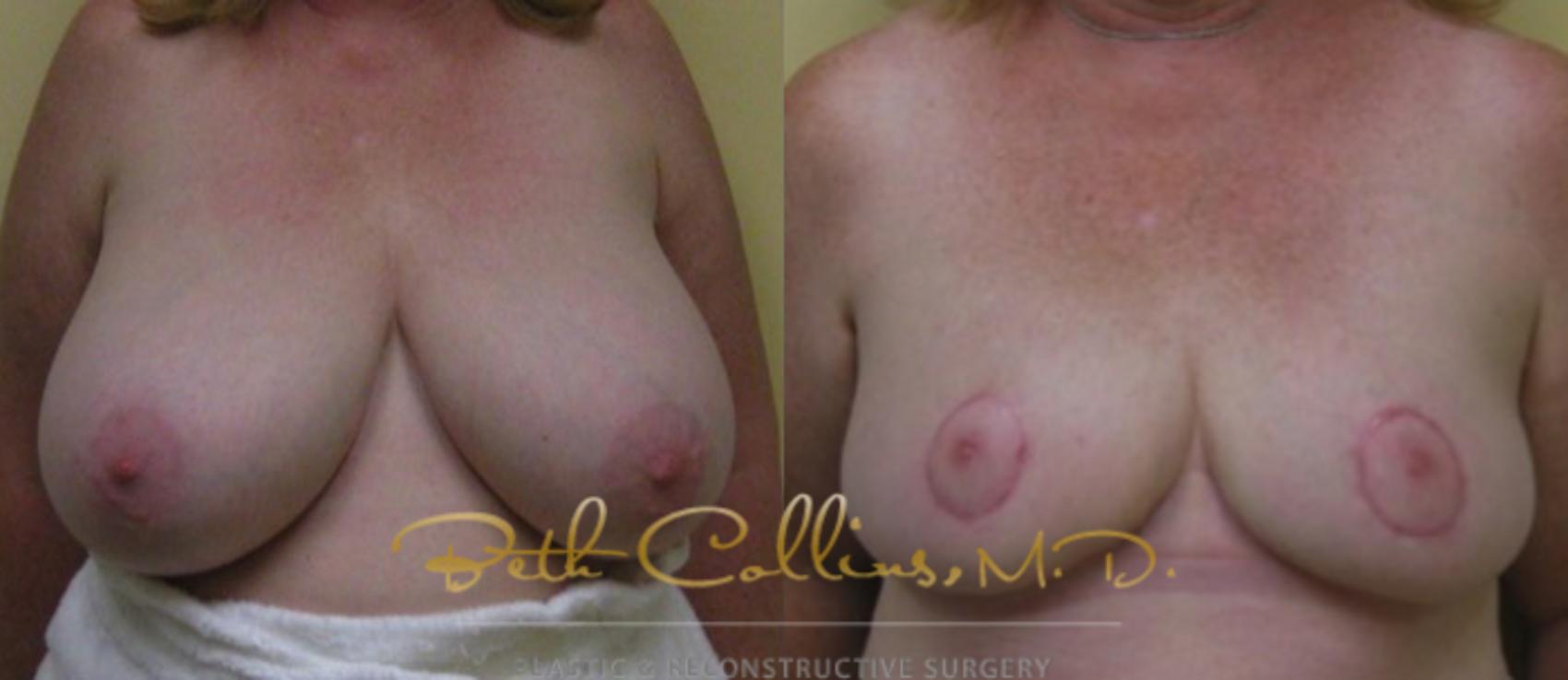 Before & After Breast Reduction Case 38 View #1 View in Guilford, CT