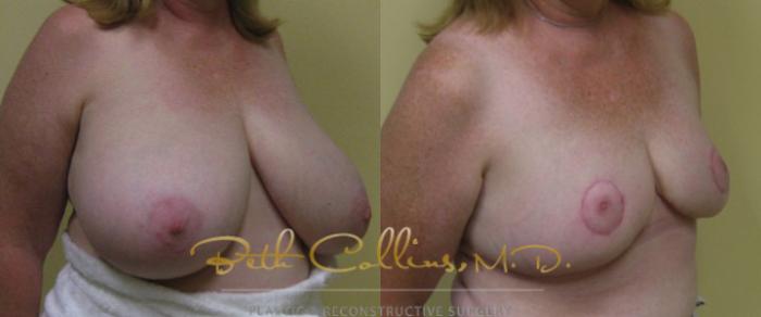 Before & After Breast Reduction Case 38 View #2 View in Guilford, CT